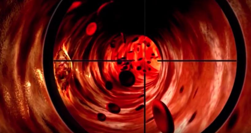 Il tumore al polmone può essere individuato con un esame del sangue